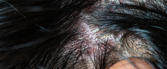 How to get rid of scalp acne